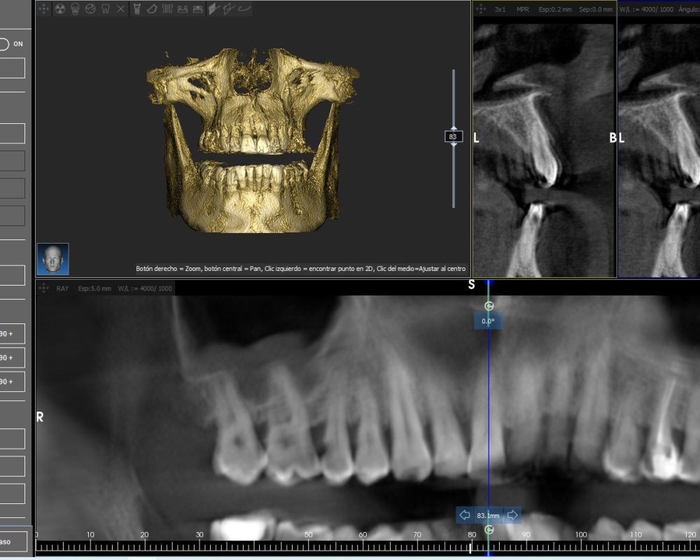 CBCT